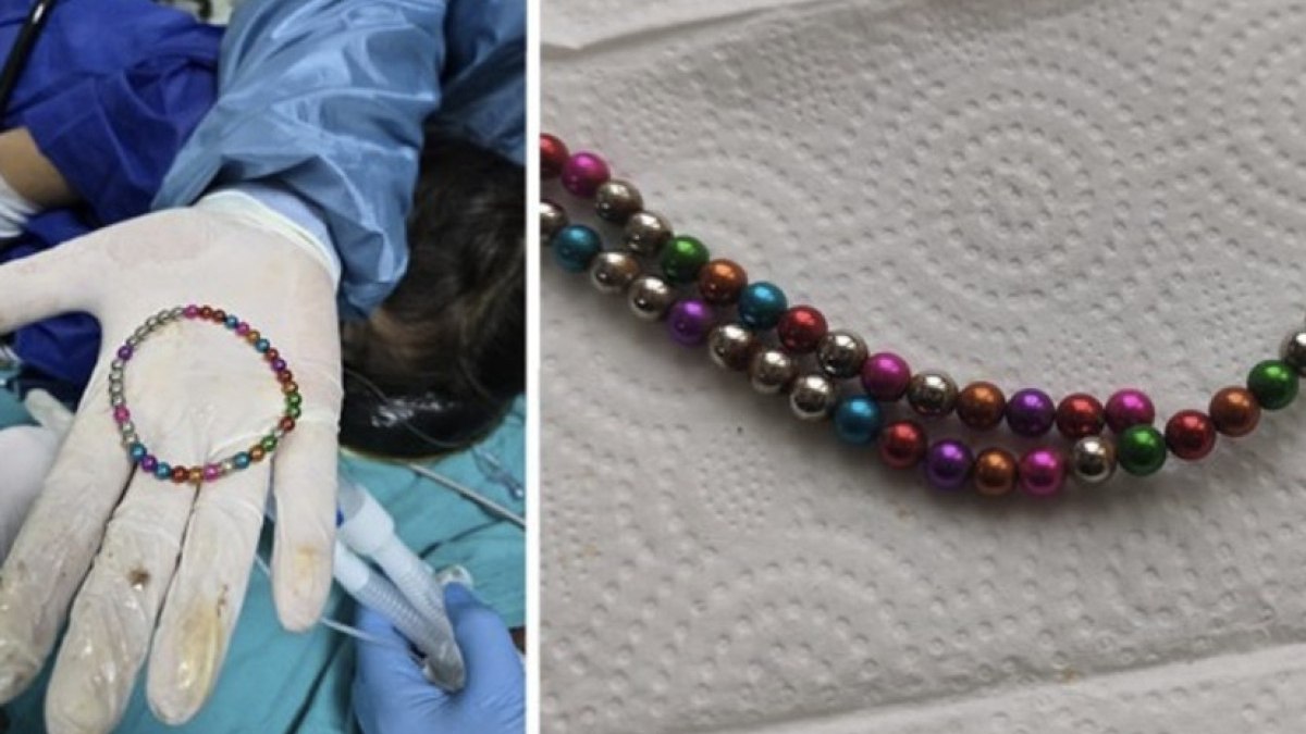 Bursa’da 5 yaşındaki çocuğun bağırsağından 38 mıknatıs çıkarıldı